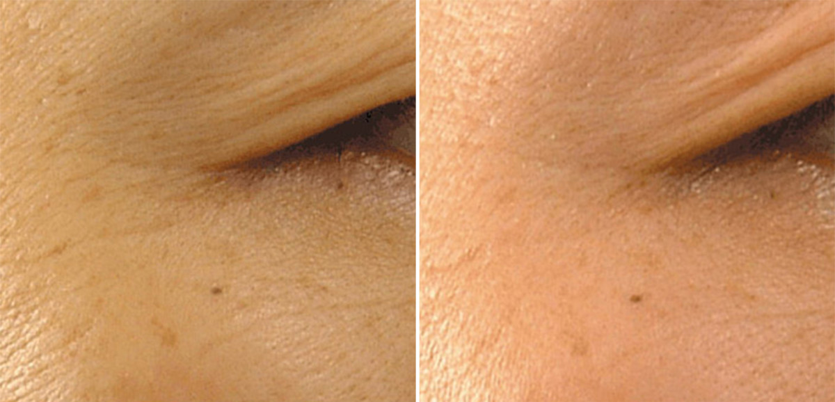 Wrinkles before and after niacinamide