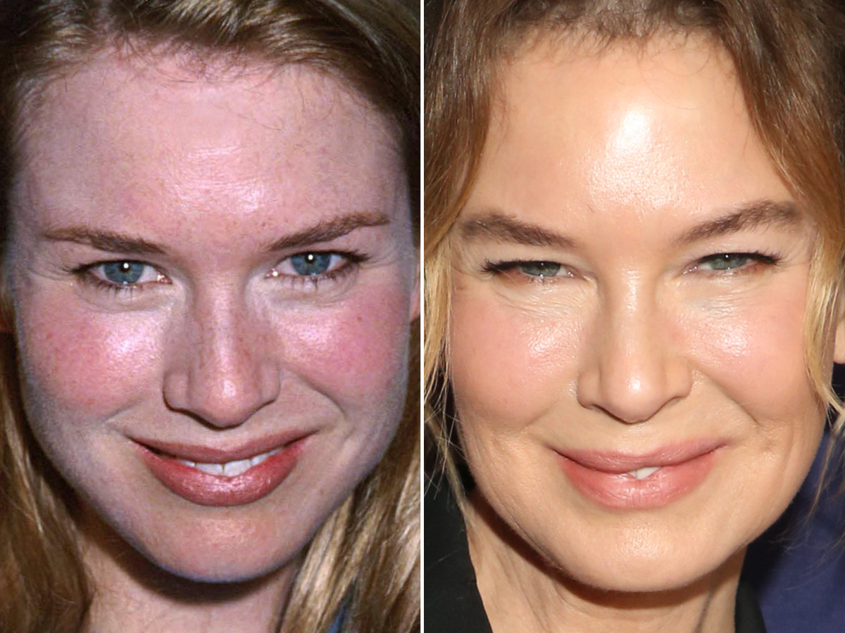Renee Zellweger before and after