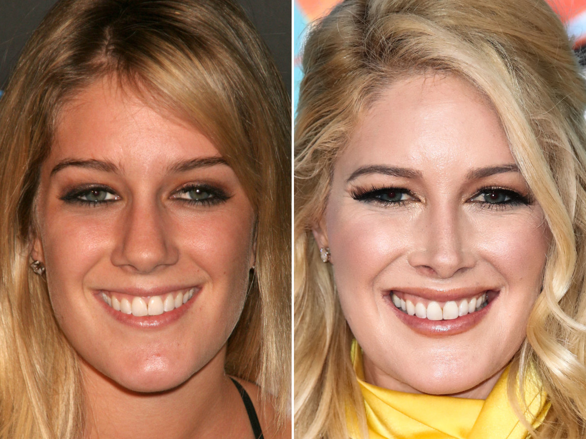 Heidi Montag Before and After From 2006 to 2022 The Skincare Edit