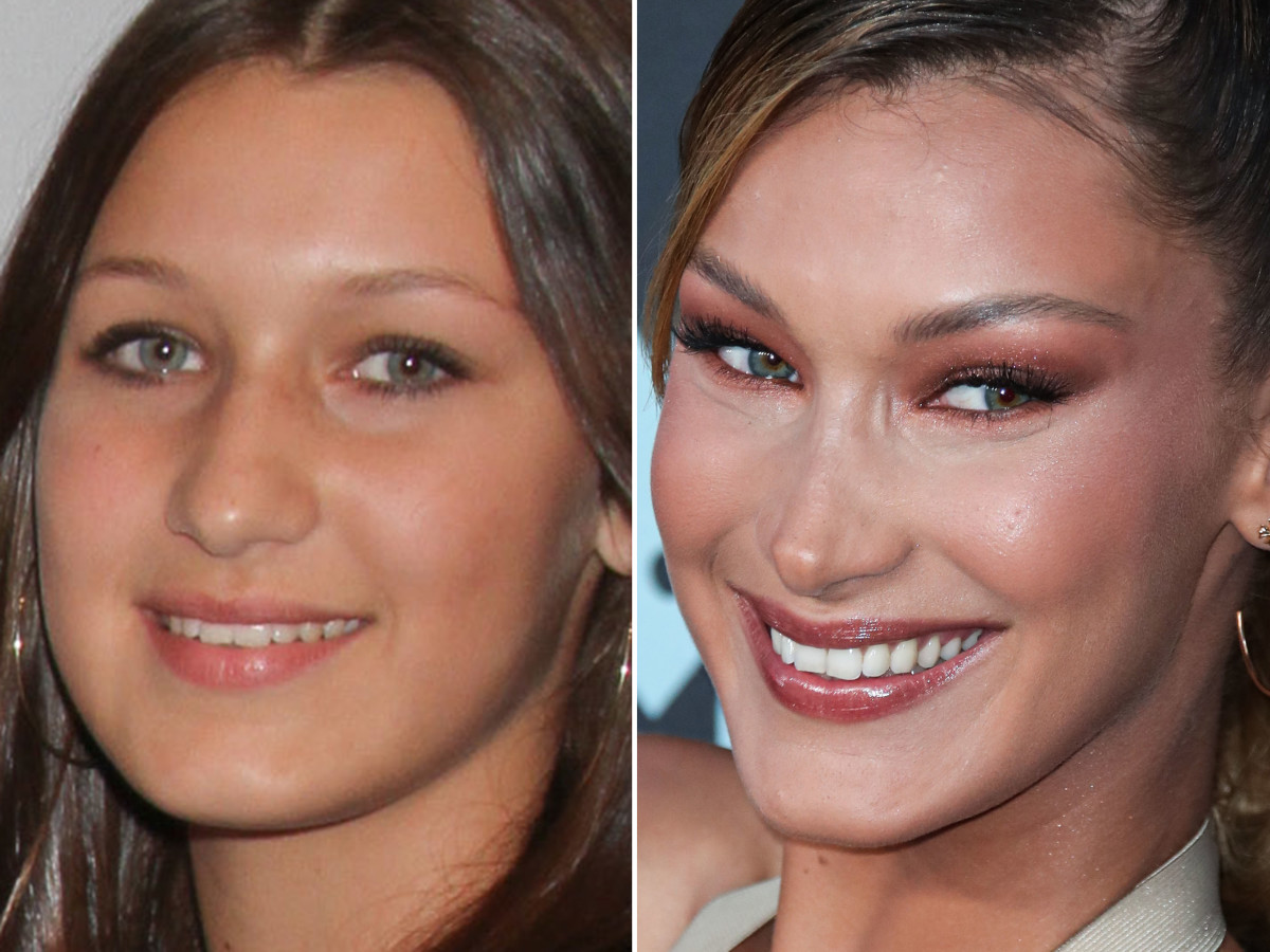Bella Hadid Before And After From 2010 To 2022 The Skincare Edit